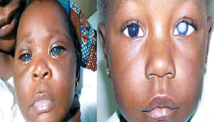 BLIND CHILDREN